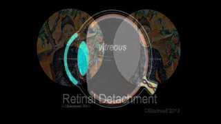 Retinal Detachment [upl. by Auhsoj]