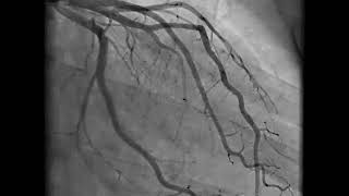 Coronary Angiography  NEJM [upl. by Ahsie]