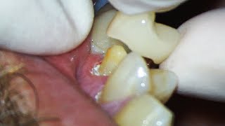 Dental Crown EXPLAINED and how much Tooth Youll Lose [upl. by Munniks]