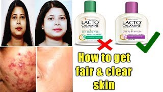 Lacto Calamine lotion reviewusesbenefitshow to get clear and fair skin [upl. by Nyleahs183]