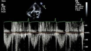 Echo Challenge Mitral Regurgitation [upl. by Sparkie]