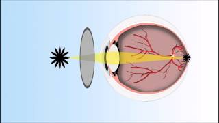 Presbyopia Explained Annimated Video [upl. by Enilecram]