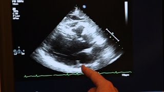 Echocardiogram Demonstration [upl. by Lihkin]