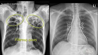 Chest x ray  Tuberculosis healed TB Inactive TB [upl. by Yhtamit112]