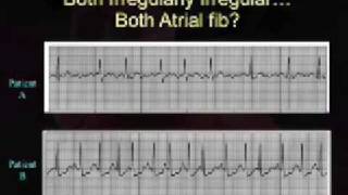 Intro EKG Interpretation Part 3 [upl. by Sadie]