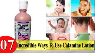 7 Incredible Ways To Use Calamine Lotion [upl. by Prouty]