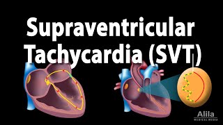 Supraventricular Tachycardia SVT PSVT Animation [upl. by Mitinger]