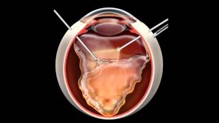 Retinal Detachment  Signs Symptoms and Treatment [upl. by Ahsin]