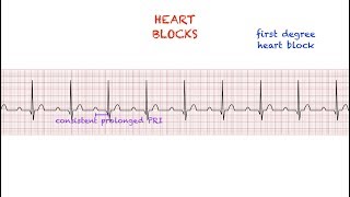 Heart Blocks Interpretation Easy and Simple [upl. by Amyas918]