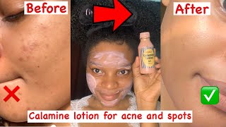 Trying out calamine lotion for Acne and dark spots for the first time Get rid of pimples✨ [upl. by Ahkihs321]