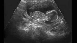 Ultrasound Fetal Response To Alcohol Fetal Alcohol Syndrome [upl. by Ainer]