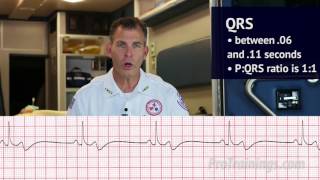 Bradycardia ECG Rhythm Interpretation [upl. by Ayaladnot658]